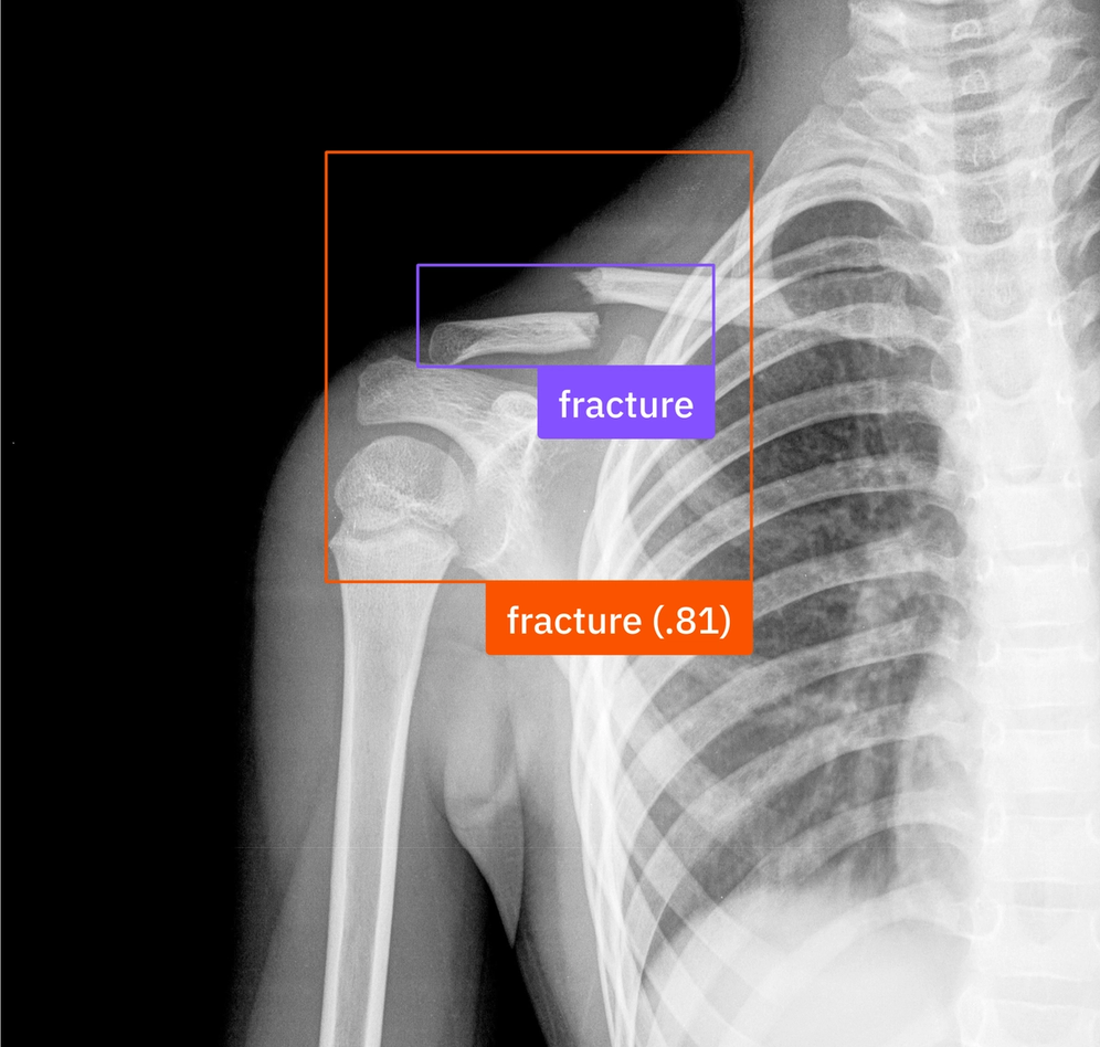 X-ray with agent-generated fracture detection boxes and confidence score